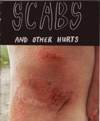 Scabs and Other Hurts